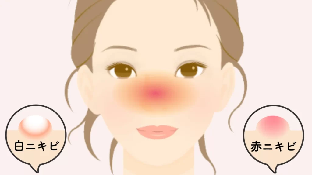 Illustration, type of acne