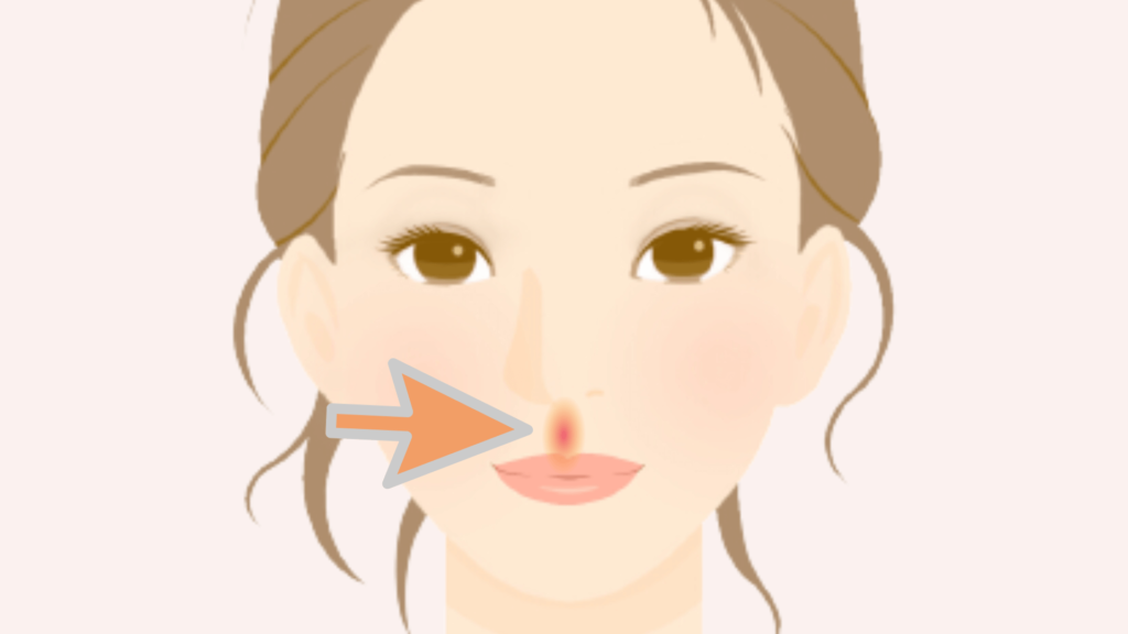 Explanatory drawing, the position of acne