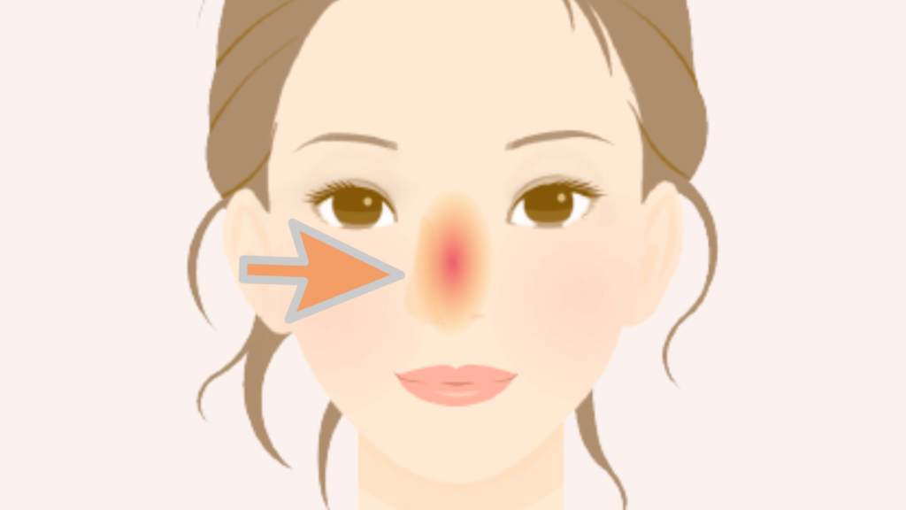 Explanatory drawing, the position of acne